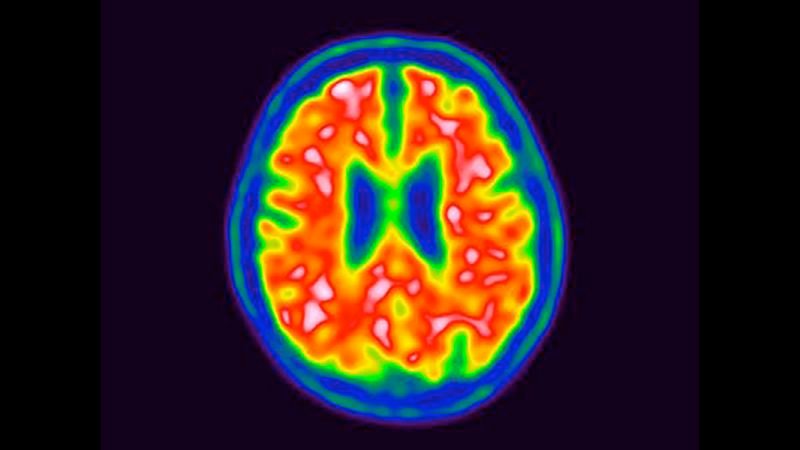 With new therapies that promise to sluggish Alzheimer’s illness, researchers race to reform how sufferers are recognized